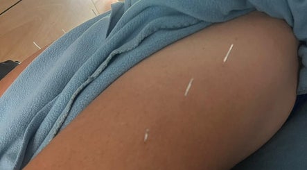 Therapeutic acupuncture session at Hoopnations (Mercury Baypark Arena), Mount Maunganui, Bay Of Plenty, NZ.