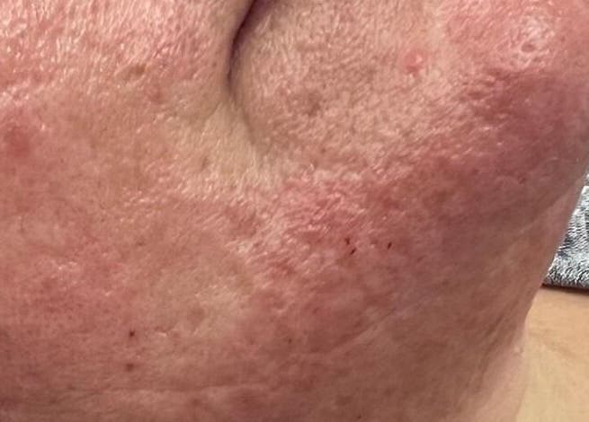 Close-up of facial skin treatment at Haven Hair Beauty & Aesthetics in Coventry, England, GB.