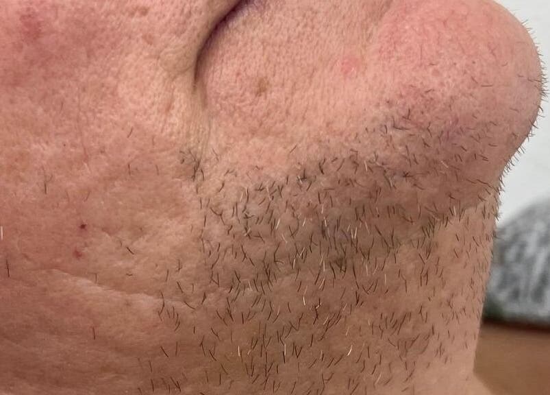Chin area showing stubble treated at Haven Hair Beauty & Aesthetics in Coventry, Coventry, England, GB.