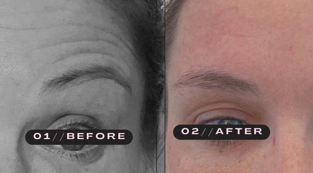 Before and after eye treatment at Lune Skin & Wellness, Melbourne, Victoria, AU, highlighting skin enhancement.