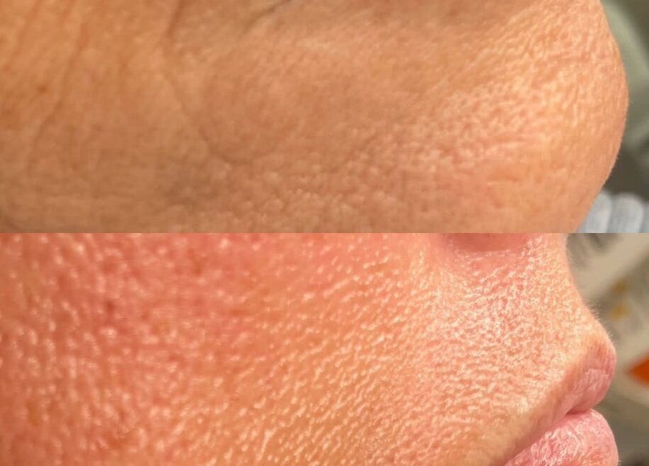 Skin transformation at Tanya at Digits in Cardiff, Wales, GB, showcasing facial rejuvenation results.