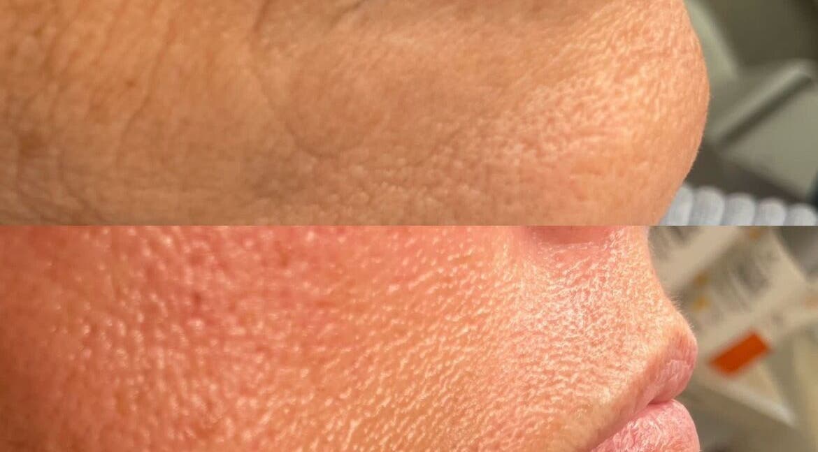 Skin transformation at Tanya at Digits in Cardiff, Wales, GB, showcasing facial rejuvenation results.