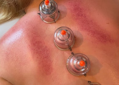 Cupping therapy at Pembrokeshire Sports Massage, Begelly, Wales, GB. Therapeutic cups on a client's back.