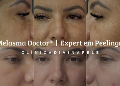 Antes e depois do tratamento de melasma na Clínica Divina Pele, São José do Rio Preto, São Paulo, BR.
