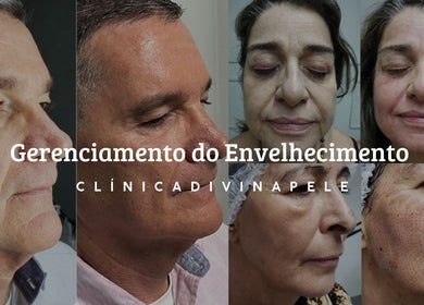 Antes e depois do tratamento antienvelhecimento na Clínica Divina Pele, São José do Rio Preto, SP, BR.