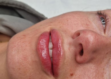 Close-up of a client's smooth, healthy skin after treatment at Nura Skin, Dudley, England, GB.