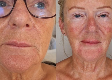 Before and after skin rejuvenation at Nura Skin, Dudley, England, GB, showcasing remarkable transformation.