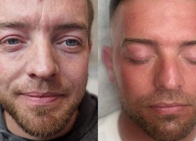 Before and after skin treatment at Nura Skin, Dudley, England, GB showcasing visible improvements.
