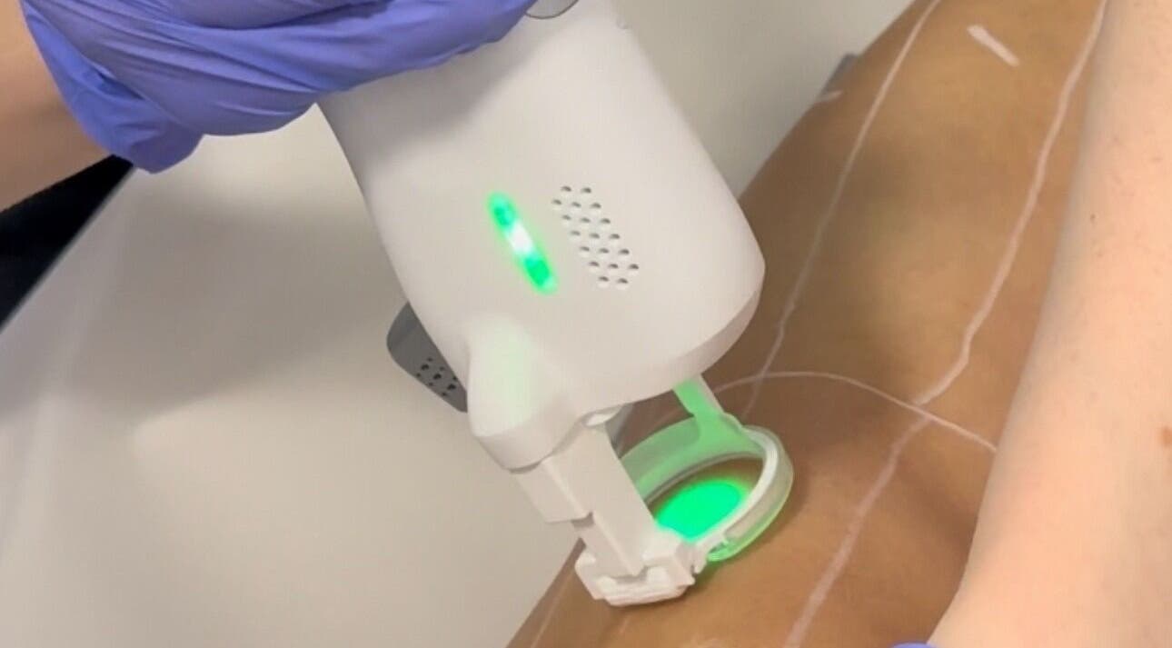 Soin laser esthétique chez Duvera à Montréal, Québec, CA, proposant des traitements avancés pour la peau.