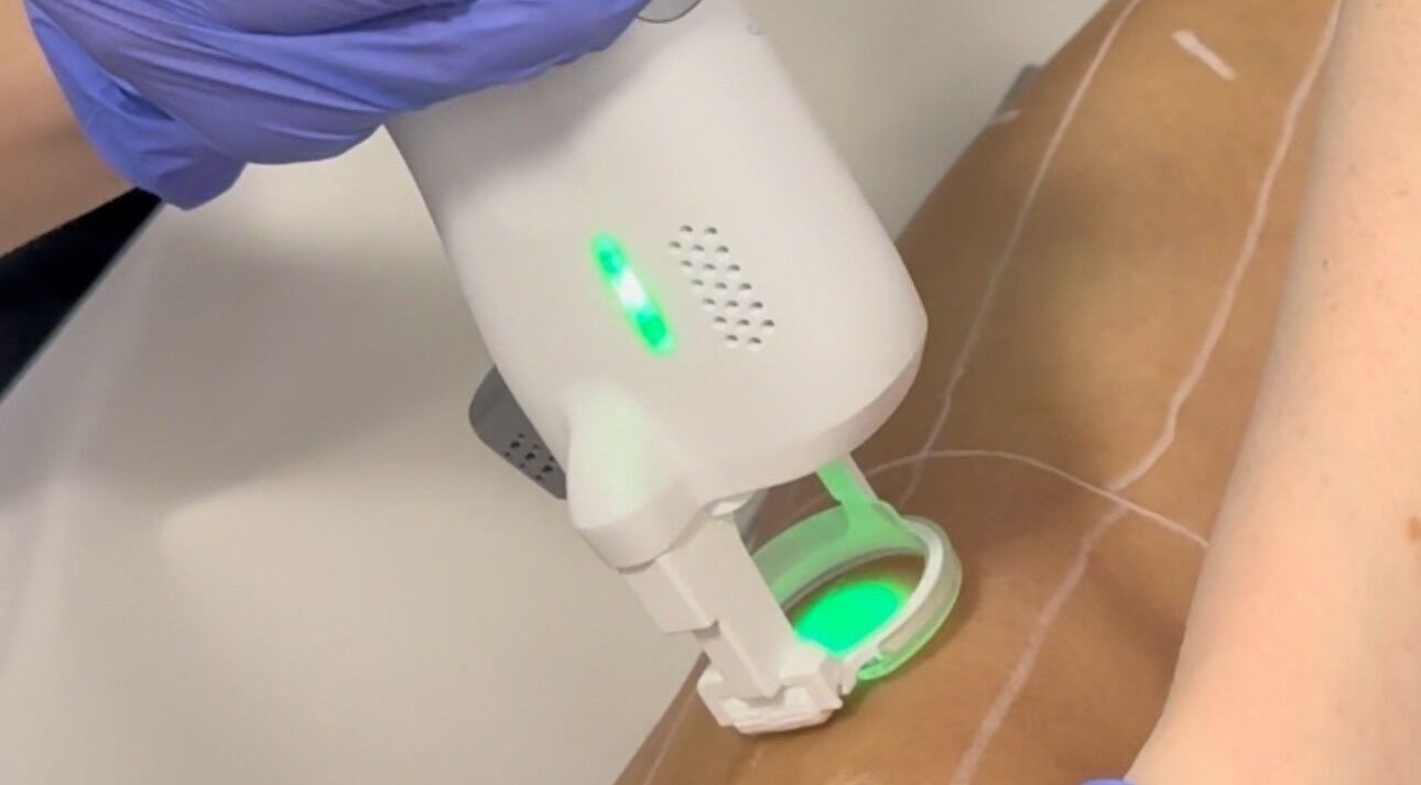 Soin laser esthétique chez Duvera à Montréal, Québec, CA, proposant des traitements avancés pour la peau.