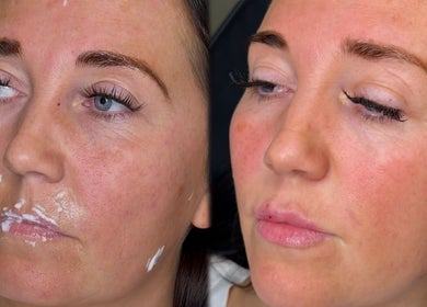 Close-up of skin transformation at Soul Sister Aesthetics in Hull, England, GB, showing before and after treatment.