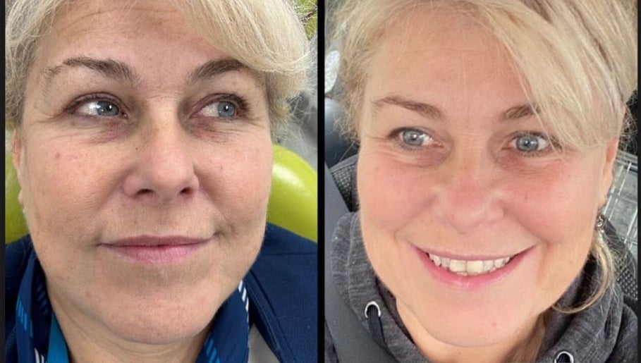Before and after facial treatment at Radieux Aesthetics, London, England, GB. Noticeable skin improvement.