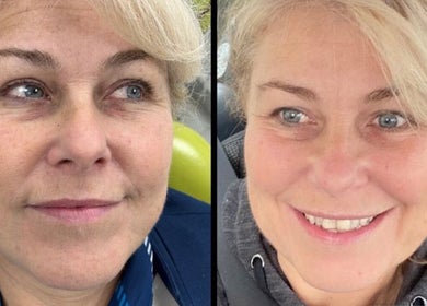 Before and after facial treatment at Radieux Aesthetics, London, England, GB. Noticeable skin improvement.