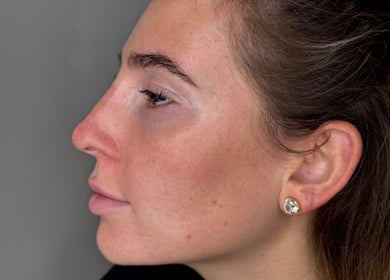 Side profile of a woman highlighting skin texture at HD Aesthetics Oxford, Kidlington, England, GB.