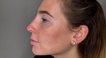 Side profile of a woman highlighting skin texture at HD Aesthetics Oxford, Kidlington, England, GB.