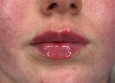 Close-up of glossy lips post-treatment at HD Aesthetics Oxford, Kidlington, England, GB.