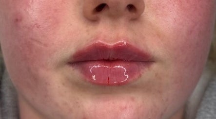 Close-up of glossy lips post-treatment at HD Aesthetics Oxford, Kidlington, England, GB.