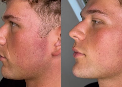 Side profile transformation at HD Aesthetics Oxford, Kidlington, England, GB shows before and after results.