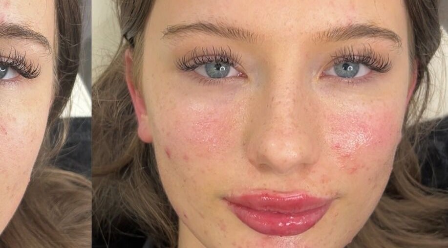 Close-up of facial beauty treatment at Aura Aesthetics Sussex in Worthing, England, GB.