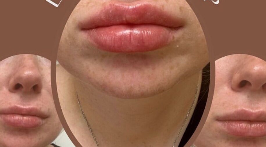 Lip enhancement results at Toxic Aesthetics, Liverpool, England, GB showcasing fuller and smoother lips.