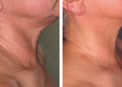 Before and after neck rejuvenation at Moon Temple Esthetics - North Admiral in Seattle, Washington, US.