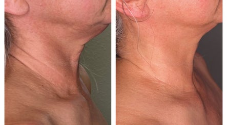 Before and after neck rejuvenation at Moon Temple Esthetics - North Admiral in Seattle, Washington, US.