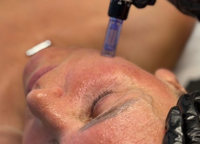 Microneedling facial at Glambitious Beauty, Hull, England, GB for rejuvenated skin.