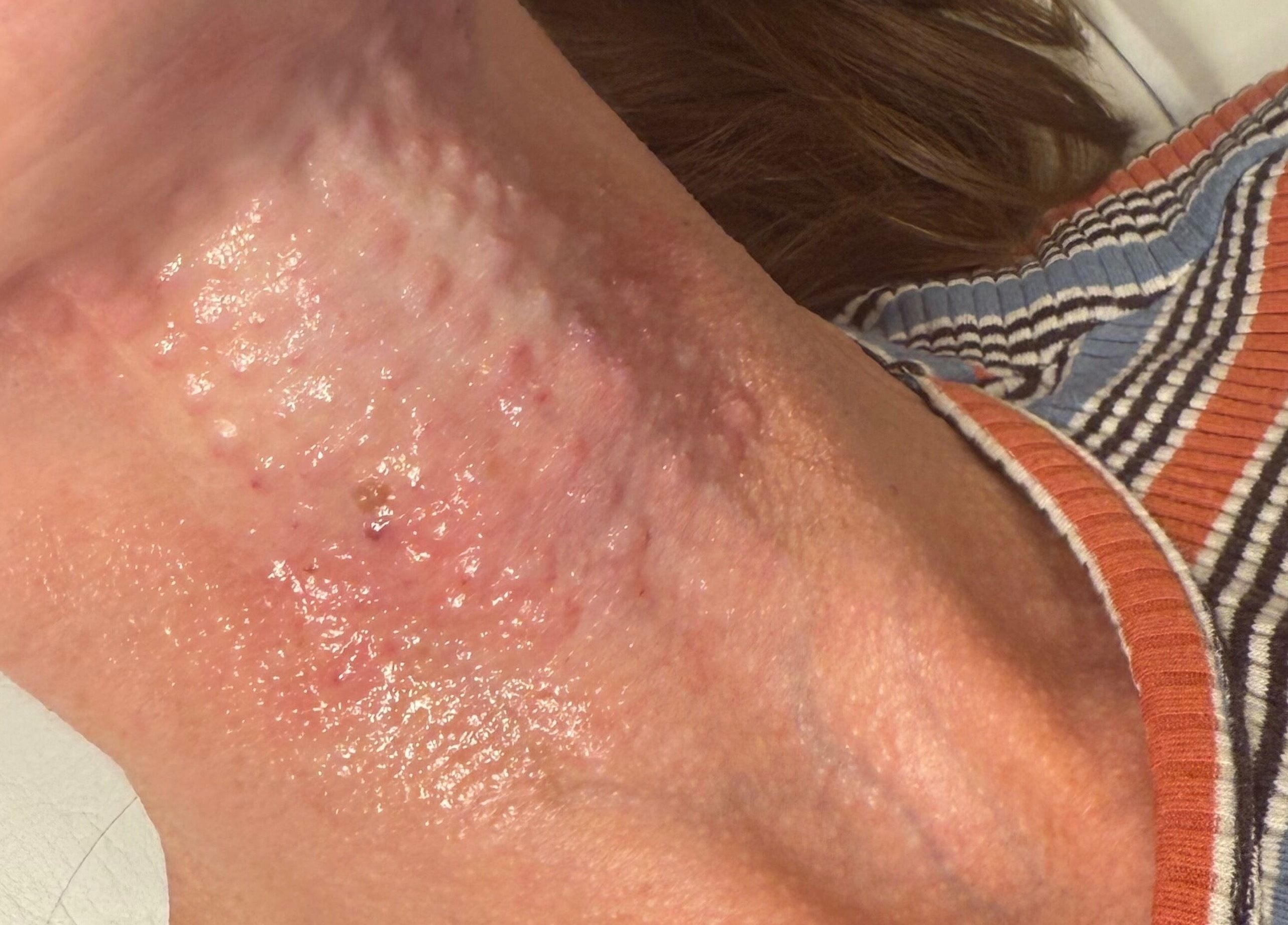 Neck skin treatment at Sculpt Aesthetics Clinic in Barlaston, England, GB for revitalized appearance.