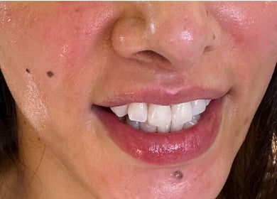 Closeup of a radiant smile post-treatment at Pure Nine Beauty, Birmingham, England, GB.
