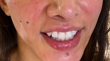 Closeup of a radiant smile post-treatment at Pure Nine Beauty, Birmingham, England, GB.