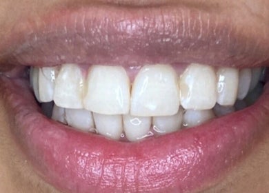 Close-up of a bright smile at Pure Nine Beauty, Birmingham, England, GB. Showcasing dental wellness.