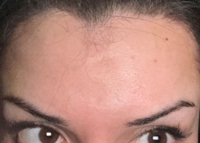 Close-up of a forehead with smooth skin at Pure Nine Beauty, Birmingham, England, GB.
