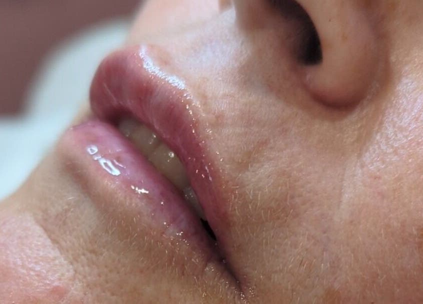 Close-up of glossy, enhanced lips at GBM Beauty Aesthetics, Ruislip, England, GB.