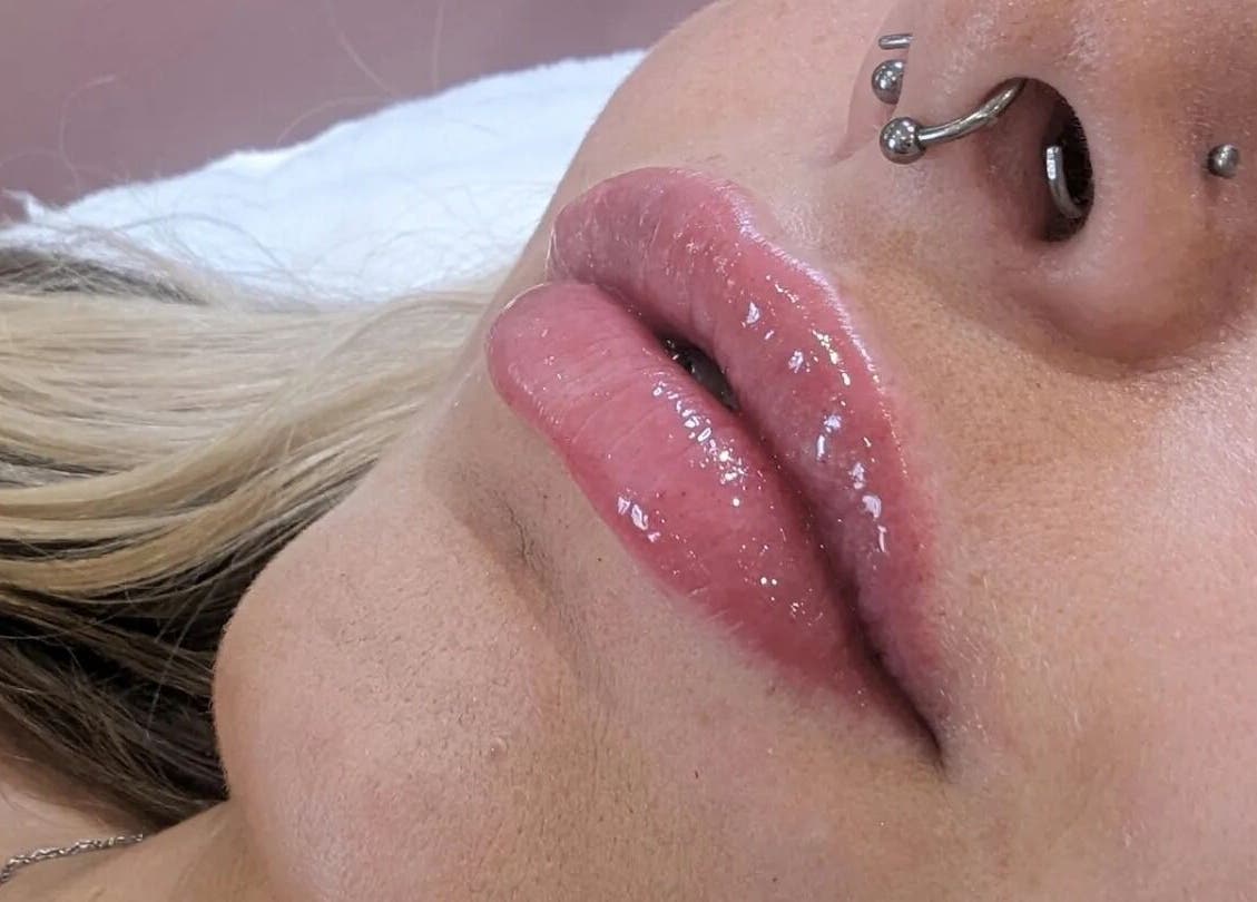 Close-up of lip enhancement at GBM Beauty Aesthetics, Ruislip, England, GB.