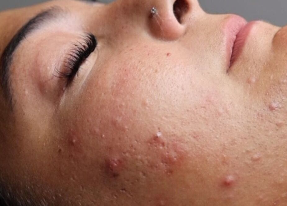 Close-up of clear skin from Fresh Faced Aesthetics, San Diego, California, US.