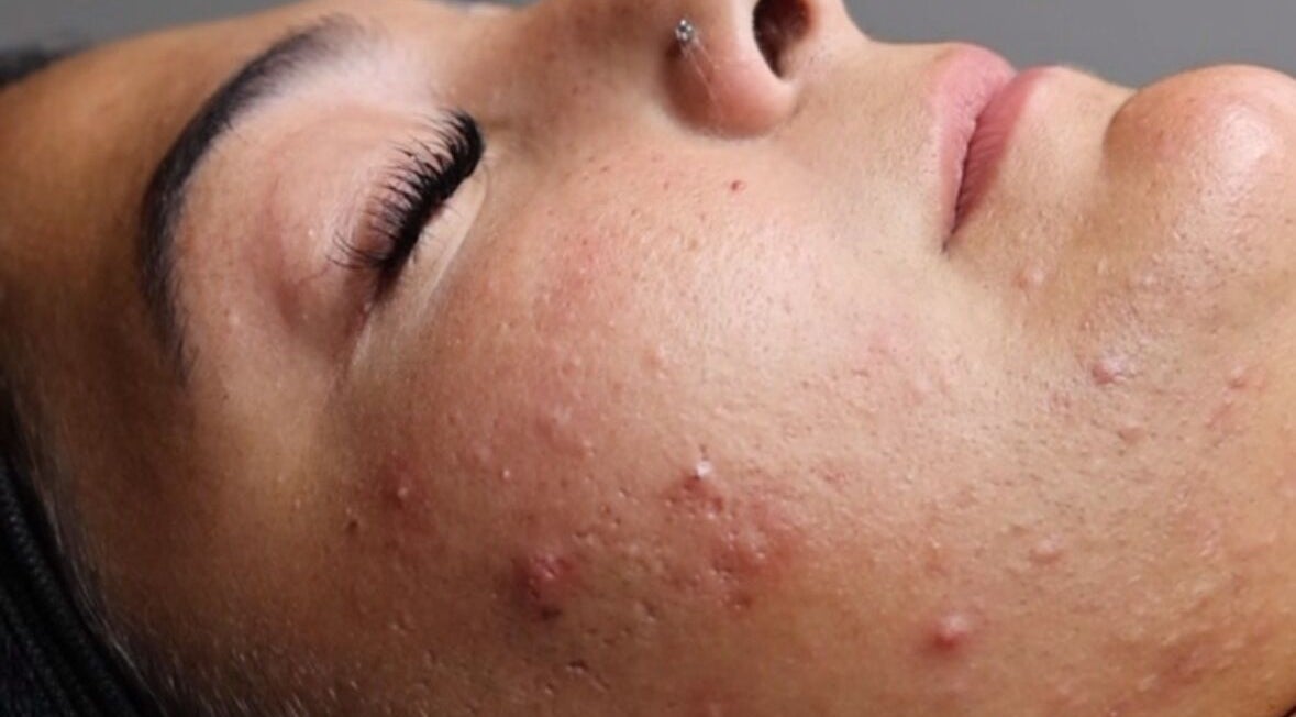 Close-up of clear skin from Fresh Faced Aesthetics, San Diego, California, US.