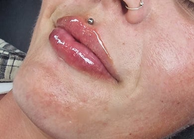 Glossy lips showcasing lip treatment at Amethyst Aesthetics Exmouth, Exmouth, England, GB.