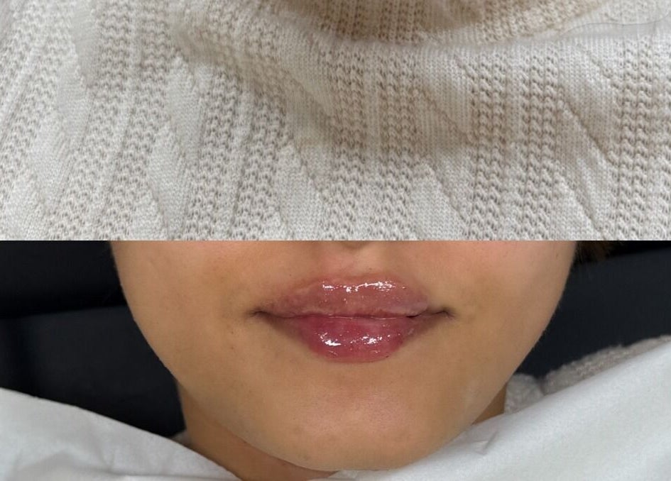 Close-up of glossy lips treatment at Anisa Aesthetics, Peterborough, England, GB.