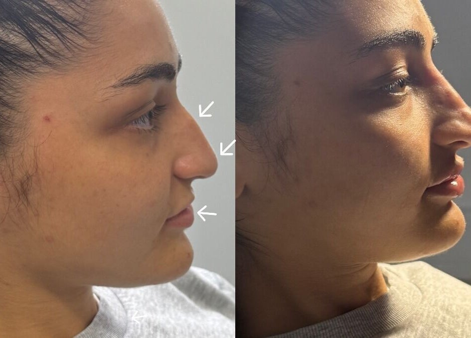 Before and after profile transformation at Anisa Aesthetics, Peterborough, England, GB.