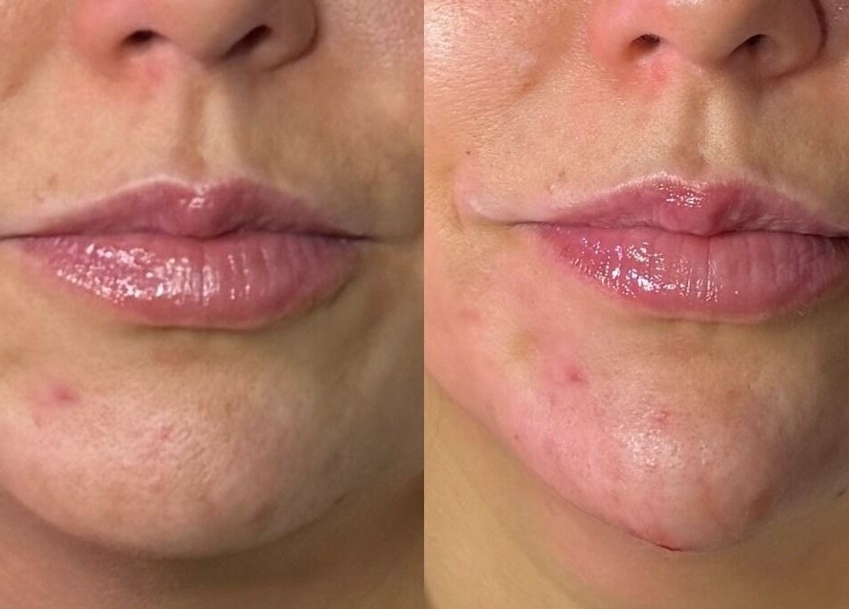 Before and after lip enhancement at Anisa Aesthetics, Peterborough, England, GB showing noticeable results.