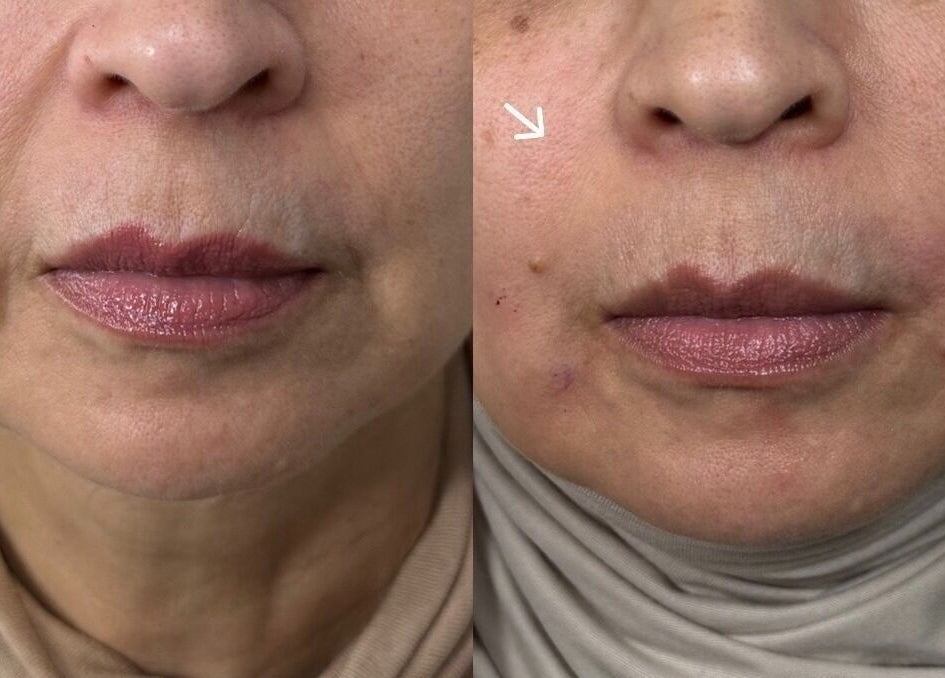 Before and after facial treatment at Anisa Aesthetics, Peterborough, England, GB showcasing skin improvement.