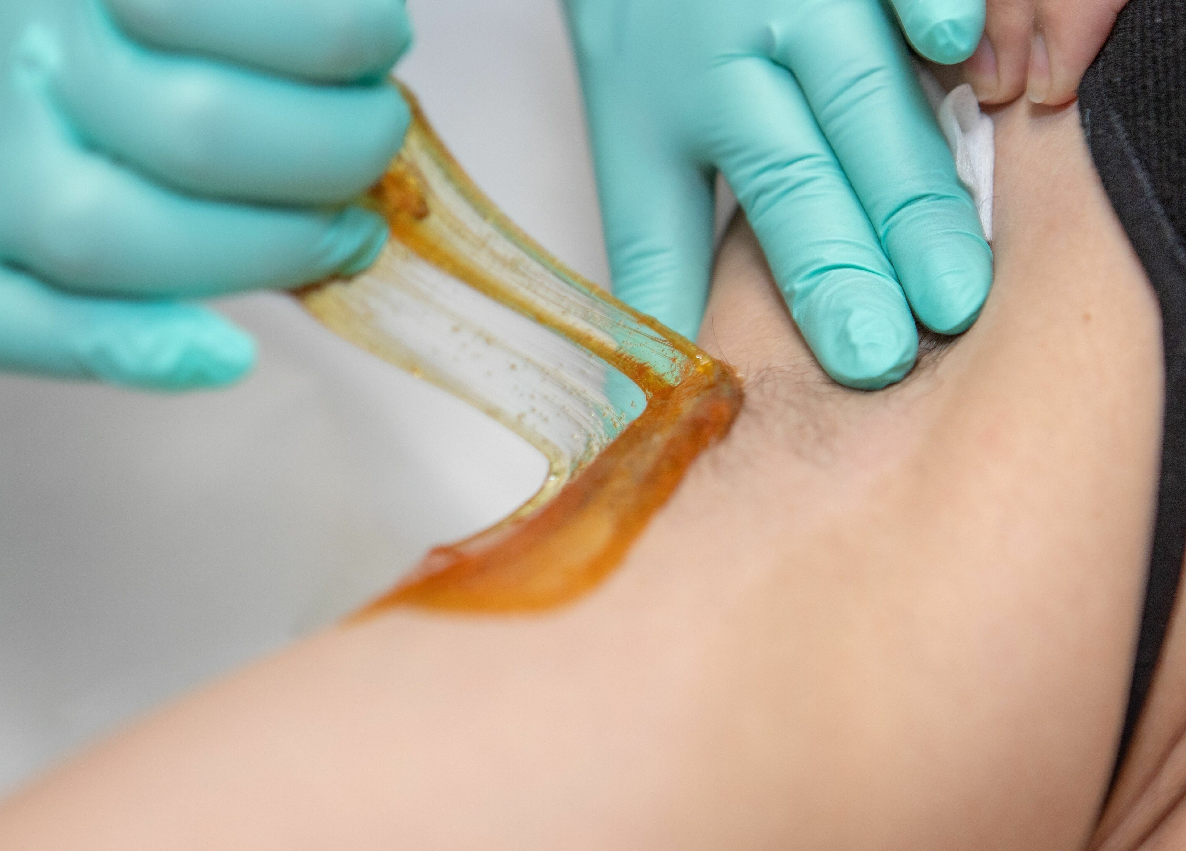 Sugaring arm treatment at Lovely Sugaring, Toronto, Ontario, CA with expert care.