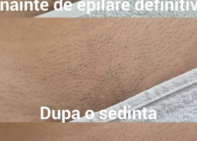Rezultatul epilării definitive la Alexandra C. Beauty Salon, București, București, RO.