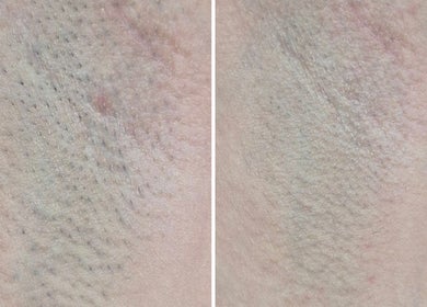 Rezultate tratament piele la Alexandra C. Beauty Salon, București, RO, înainte și după
