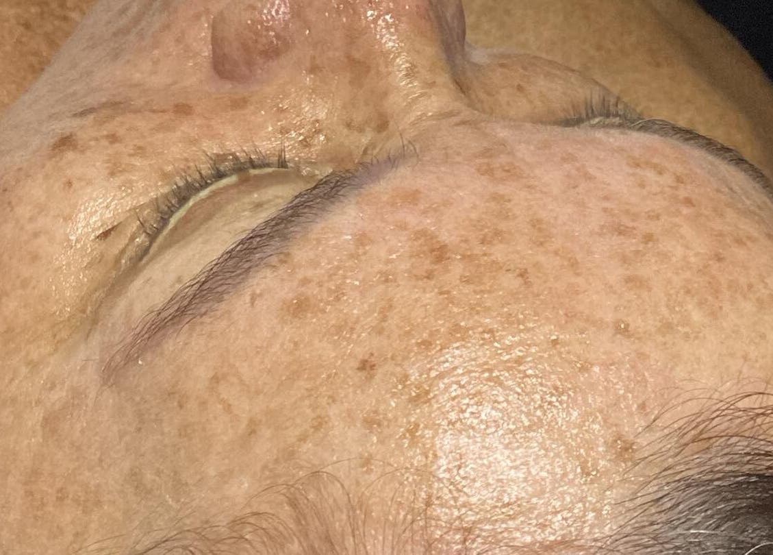 Tratamiento facial en Amore Sui Aesthetic en Lajas, lajas, PR, mostrando piel rejuvenecida.