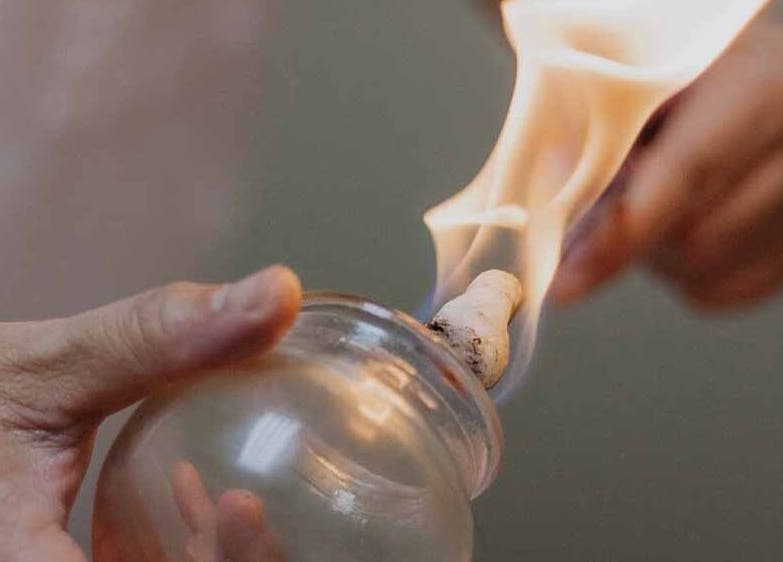 Fire cupping therapy at Caroline at Ritual Therapies, Birmingham, England, GB.