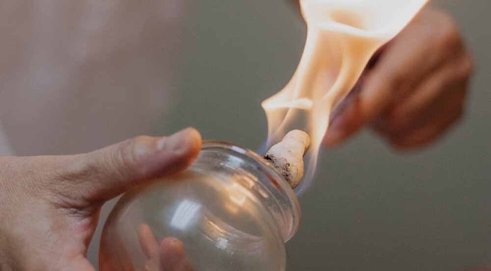 Fire cupping therapy at Caroline at Ritual Therapies, Birmingham, England, GB.