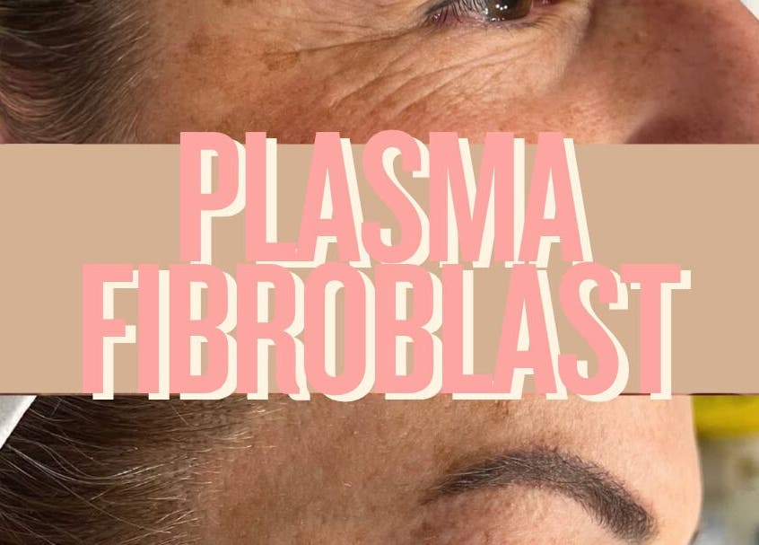 Plasma Fibroblast treatment at Tam’s Lash Studio & Radiant Skin Aesthetics, Umhlanga, KwaZulu-Natal, ZA.