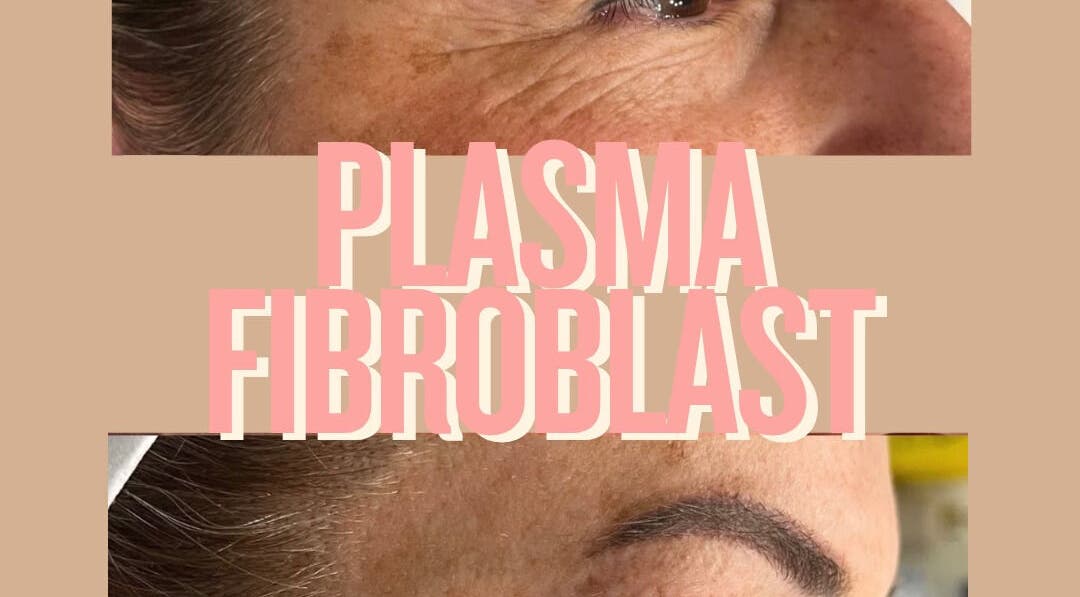 Plasma Fibroblast treatment at Tam’s Lash Studio & Radiant Skin Aesthetics, Umhlanga, KwaZulu-Natal, ZA.