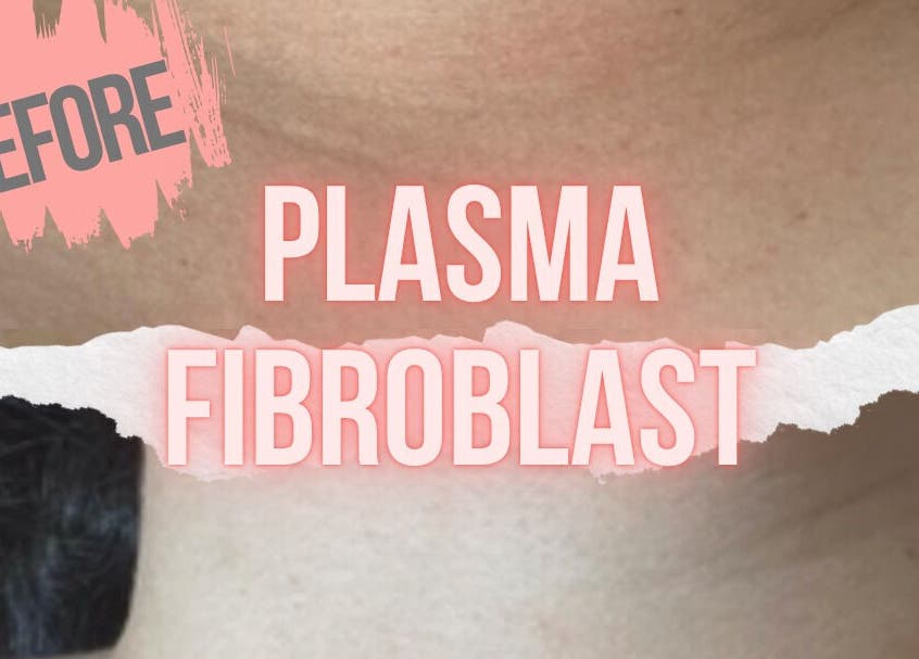 Plasma Fibroblast treatment at Tam’s Lash Studio & Radiant Skin Aesthetics, Umhlanga, KwaZulu-Natal, ZA.